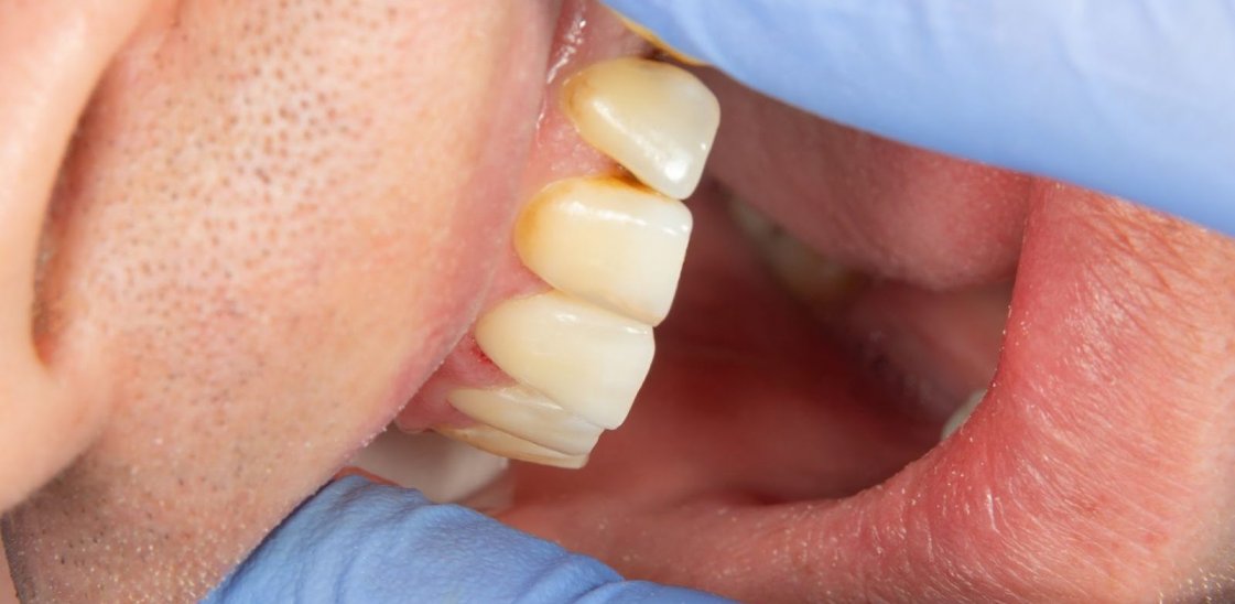 a man at the dentist with yellow plaque growing around the top edges of his teeth