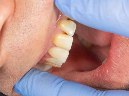 Wat is tandplak en hoe ziet het eruit?