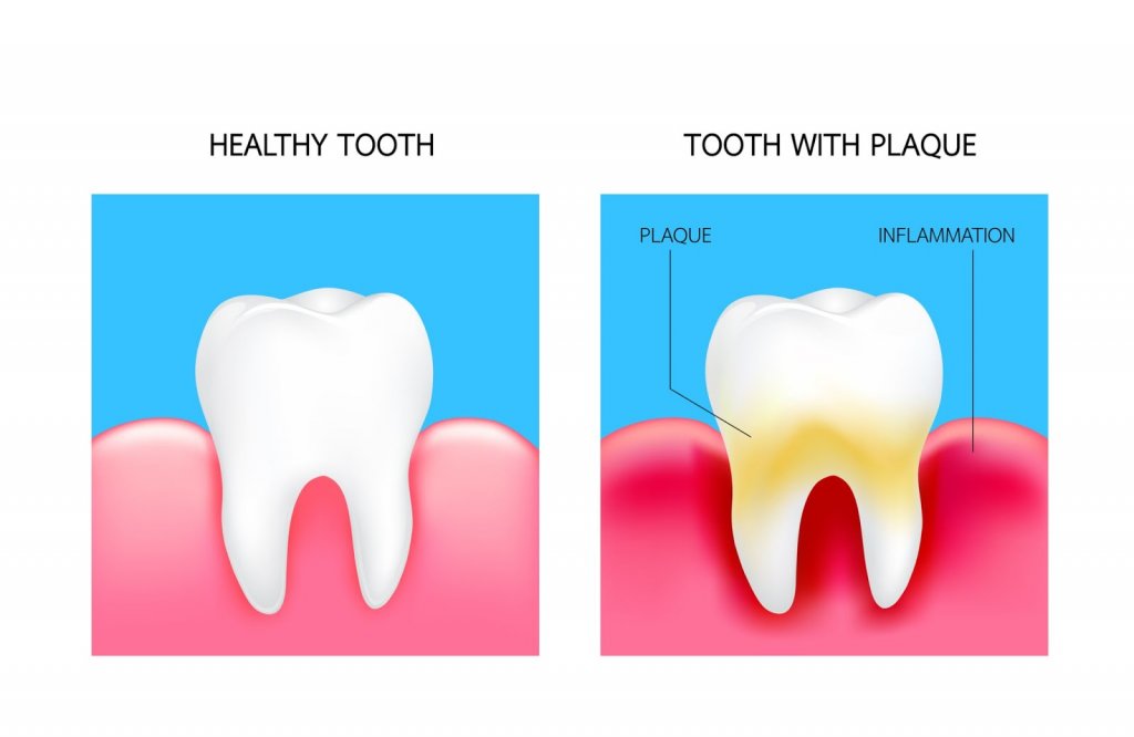 A diagram of a healthy tooth vs. one that has plaque build up