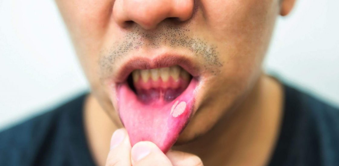 A man holding out his lip, displaying a mouth ulcer