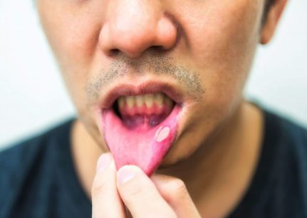 Mouth ulcers – causes and treatments