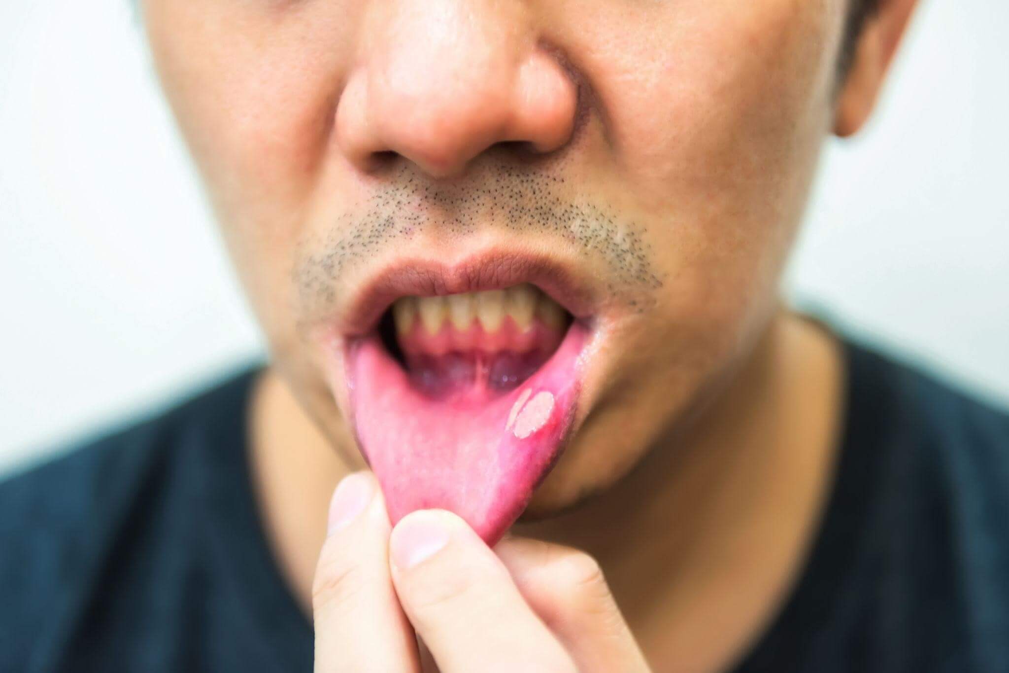 Mouth Ulcers Causes And Treatments Dentek