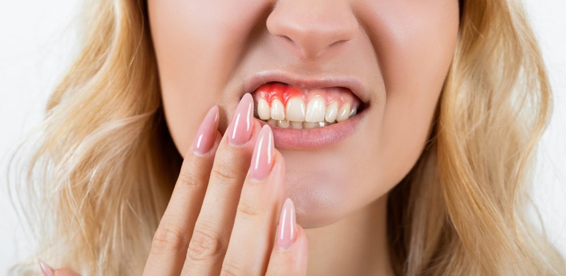 A woman suffering with painful, inflamed gums