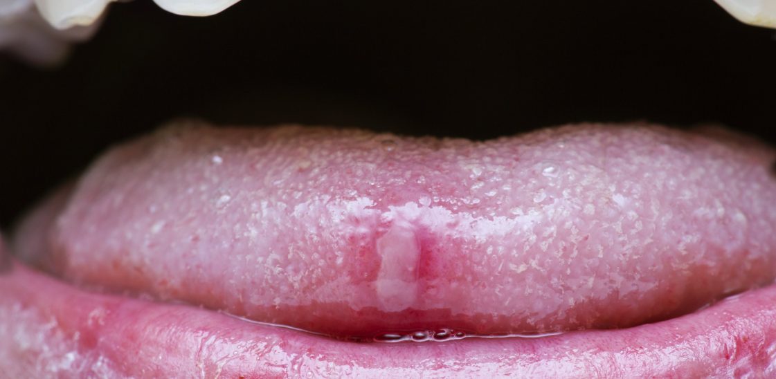 A canker sore or mouth ulcer on someone’s tongue.