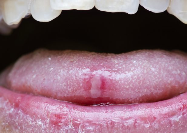 What is a canker sore?