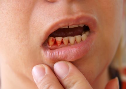 What is gum infection?