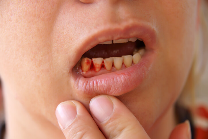 A person holds down their lower lip to reveal bleeding gums