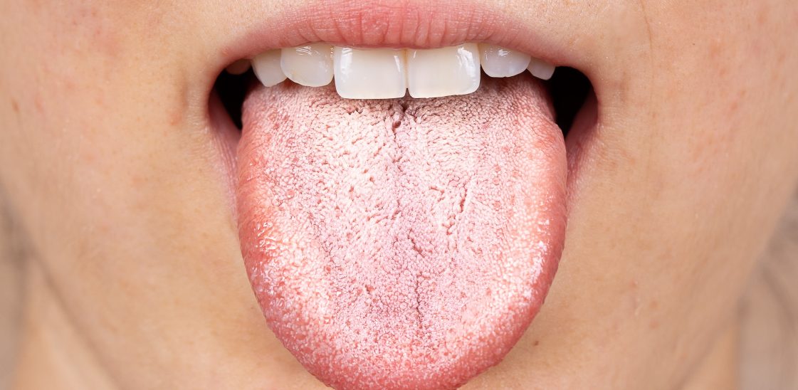 A person sticks their tongue out, revealing a large white patch on the surface.
