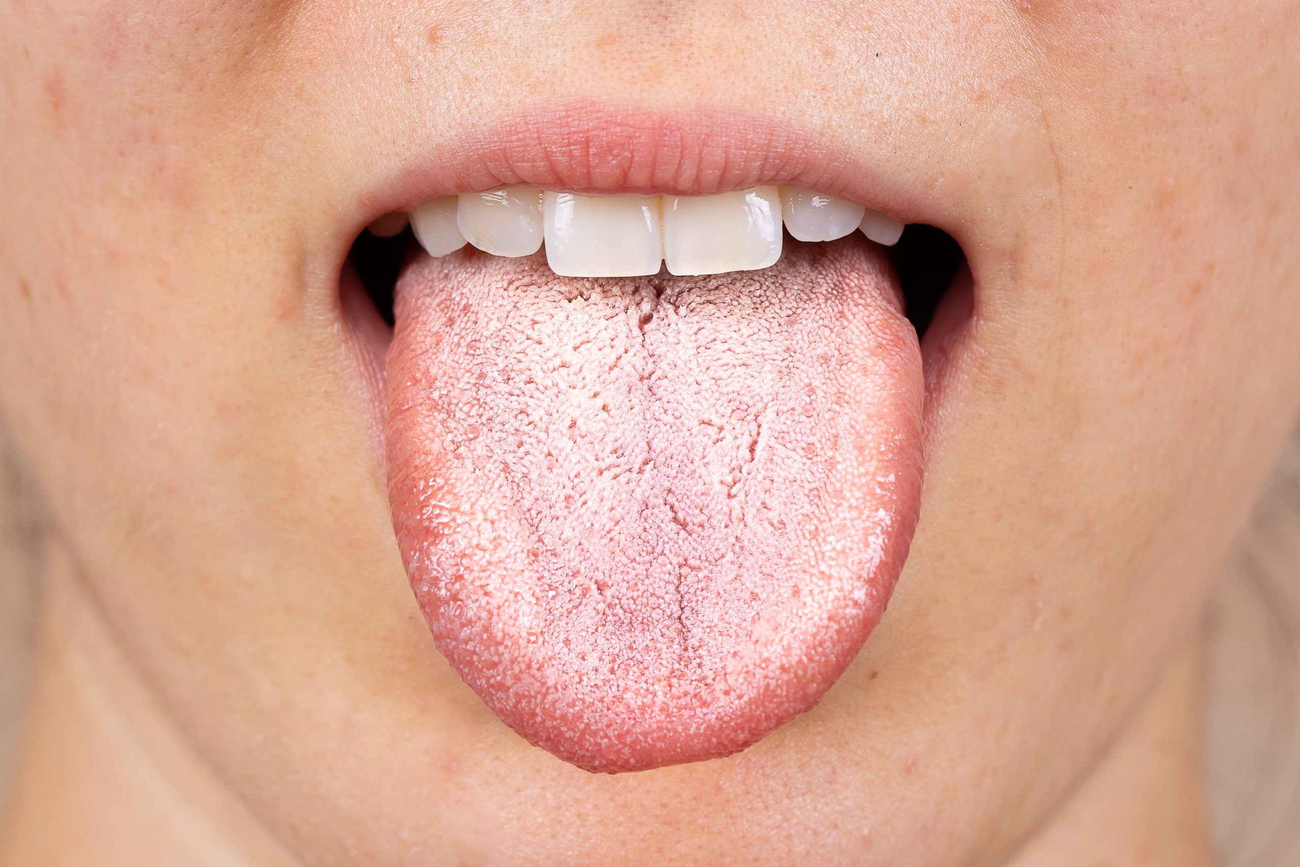 3 Year Old Has White Patch On Tongue