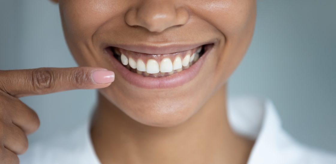 A woman smiling pointing to her teeth