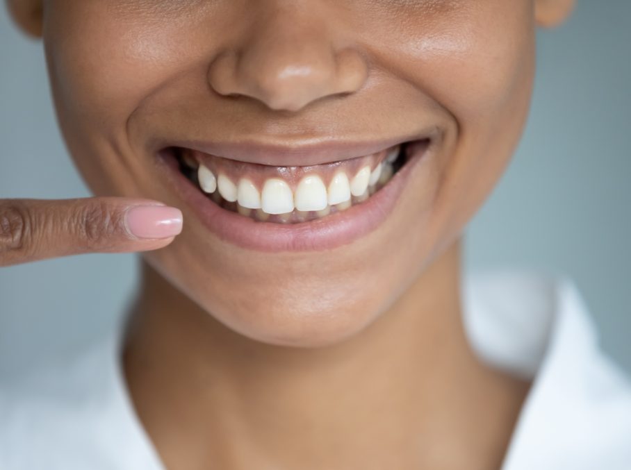 A woman smiling pointing to her teeth