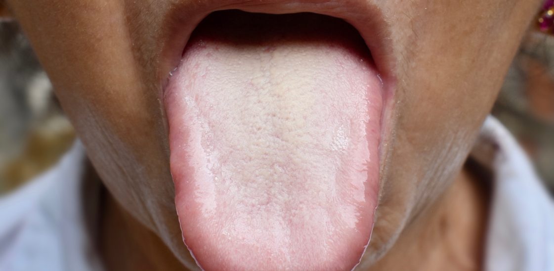 A person sticking their tongue out to show their white tongue