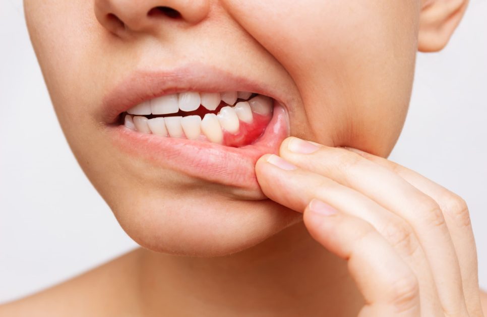 How to treat gum disease without a dentist