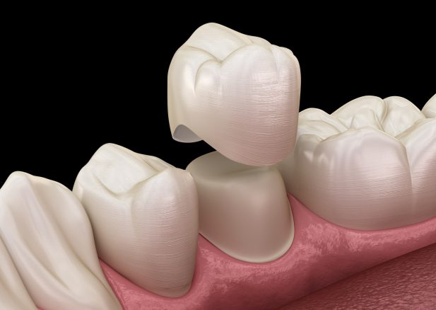 What is a crown on a tooth?