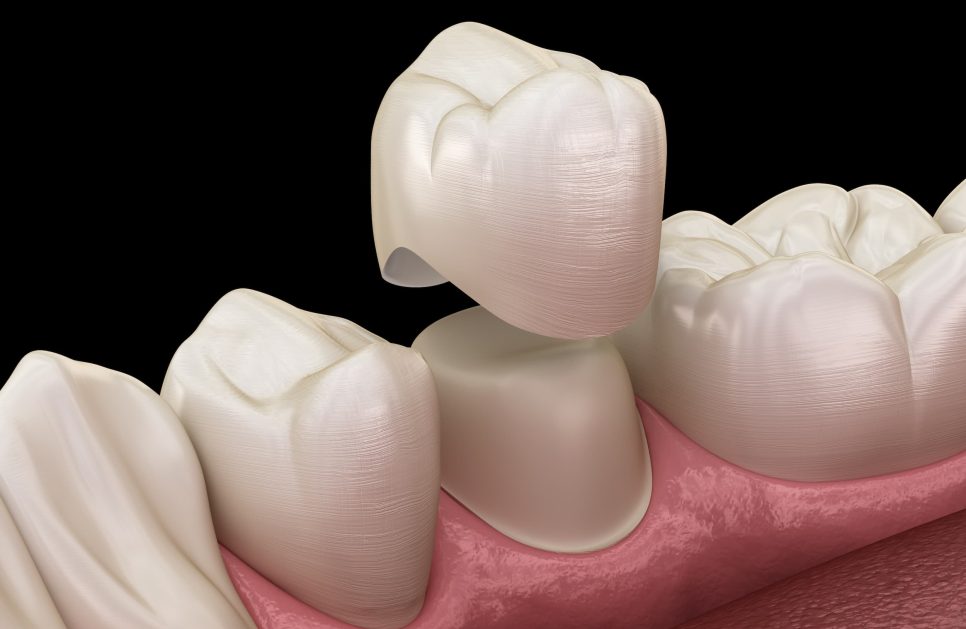 What is a crown on a tooth?