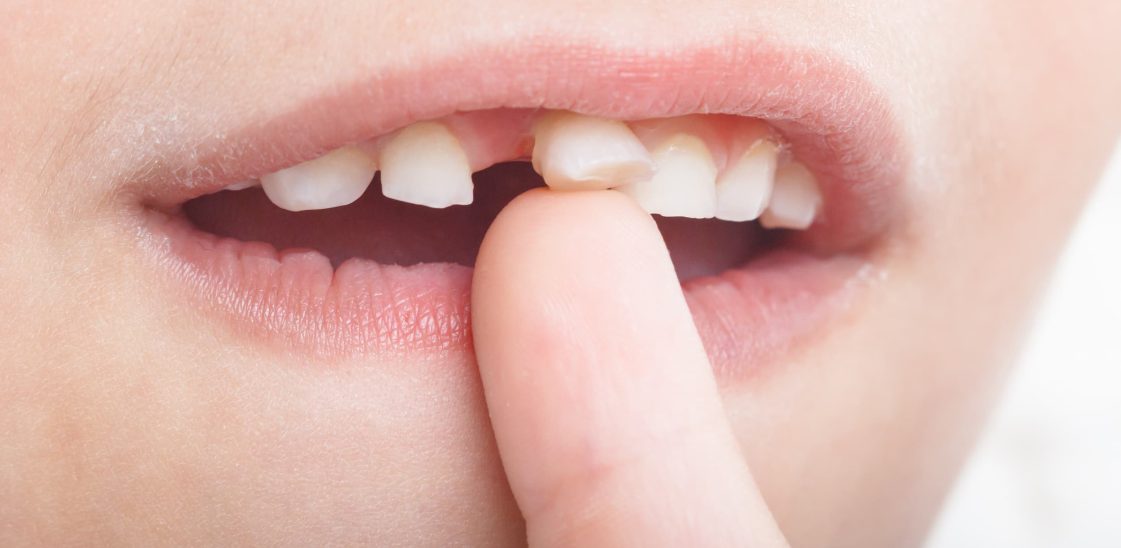 Close-up of a young child wobbling a loose tooth.