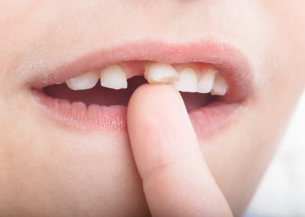 Can a loose tooth be saved?