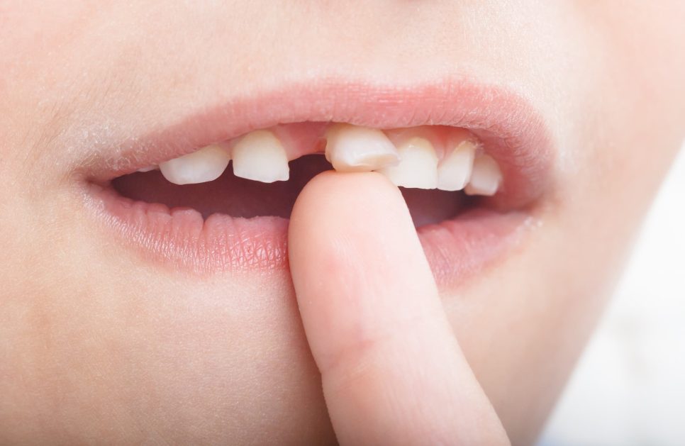 Can a loose tooth be saved?
