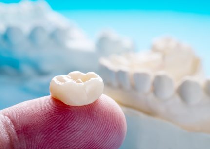 How long do dental crowns last?