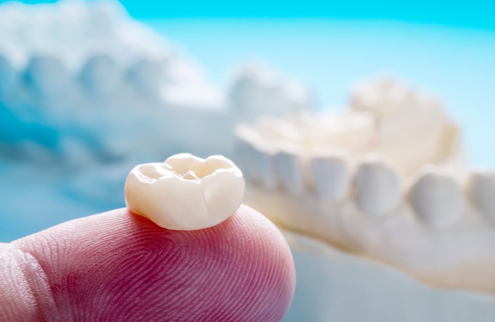 How long do dental crowns last?