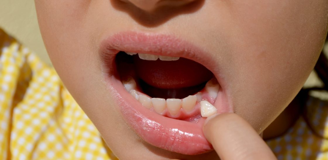 A child wobbles their loose tooth.