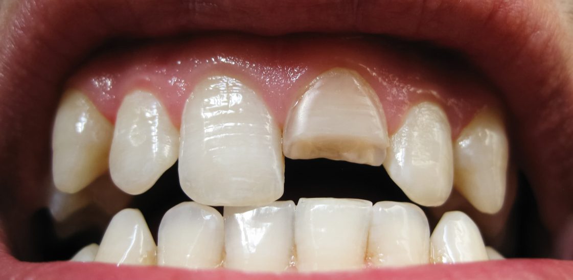 A close-up photo of a person’s front teeth with a broken upper incisor.