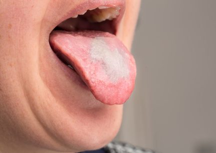 What does oral thrush look like?
