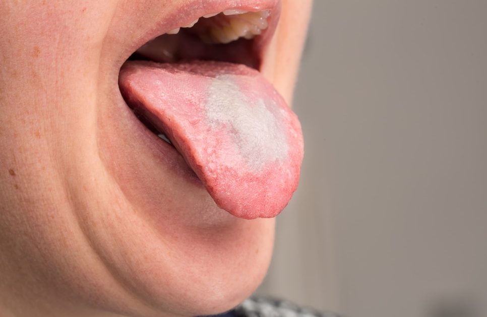 What does oral thrush look like?