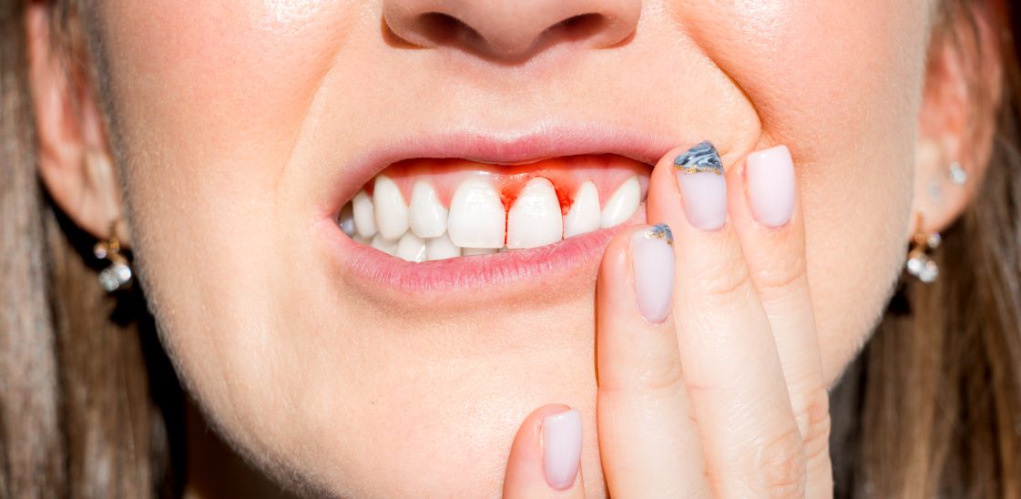 A woman lifts up her upper lip to examine her bleeding gums.