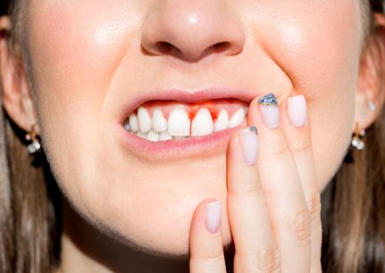 Why are my gums bleeding?
