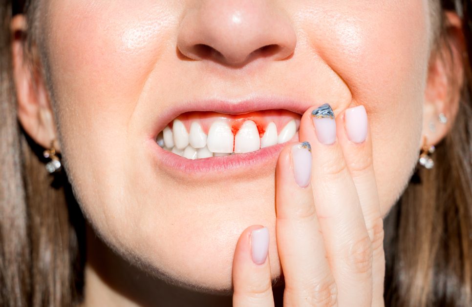 Why are my gums bleeding?